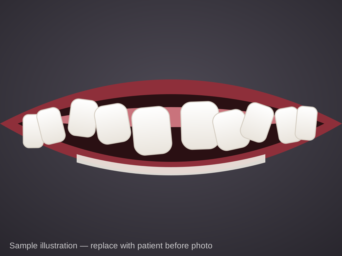 Before (sample illustration): Braces, age 13