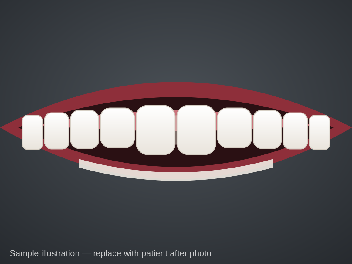 After (sample illustration): Palate expander, age 9