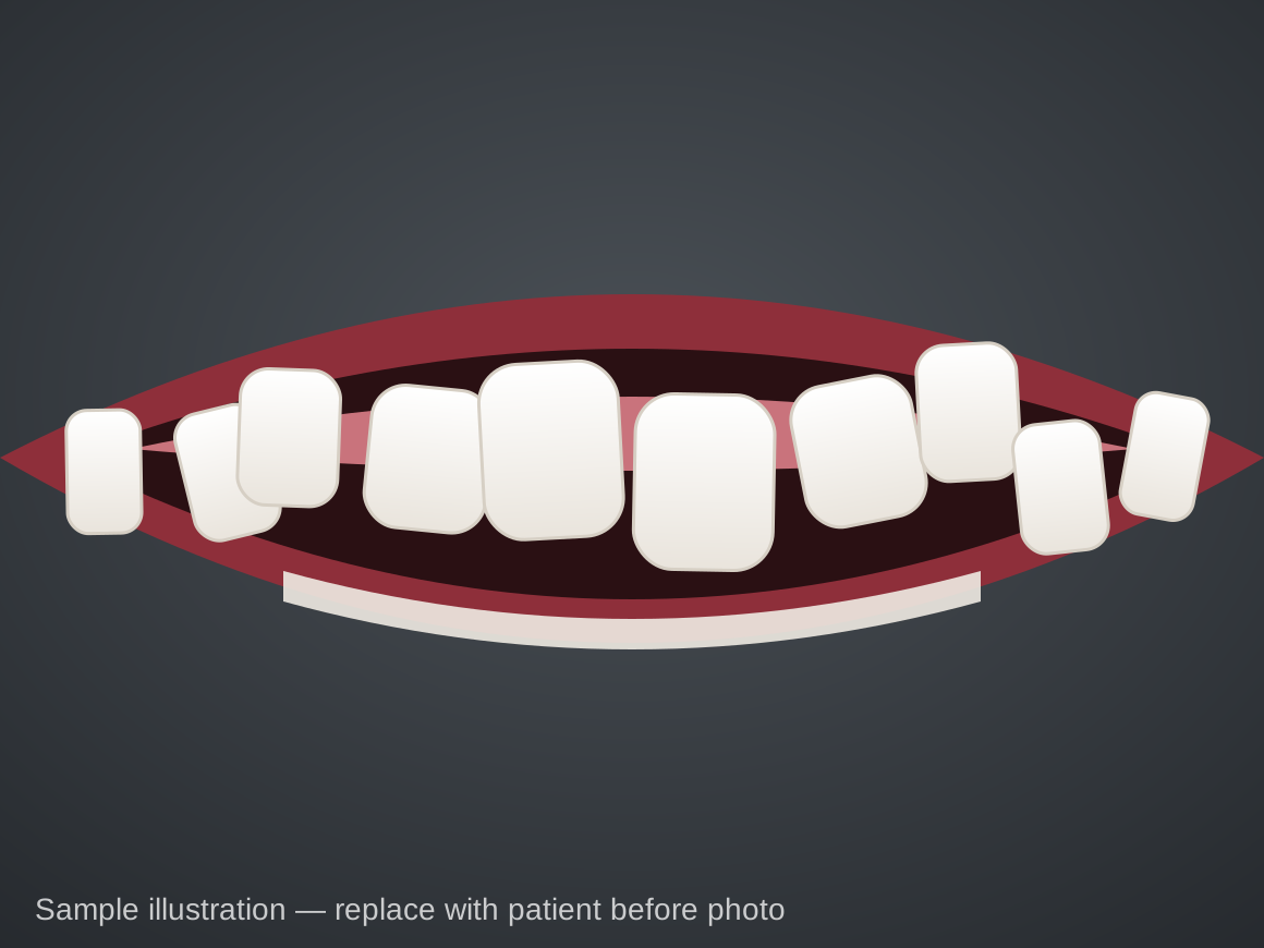 Before (sample illustration): Palate expander, age 9