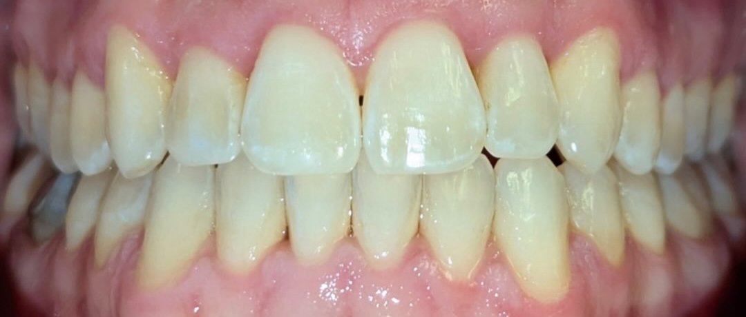 After: Invisalign · real Dynamic Smiles case