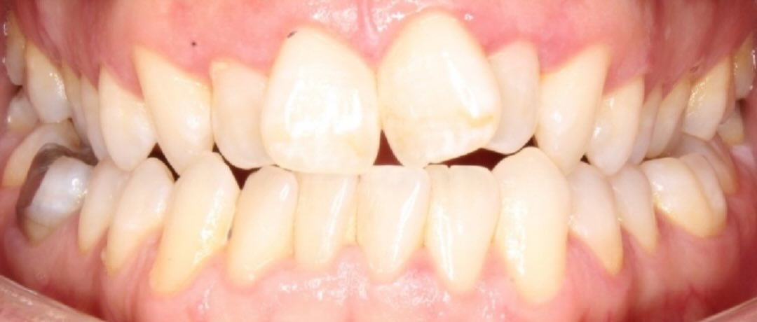 Before: Invisalign · real Dynamic Smiles case